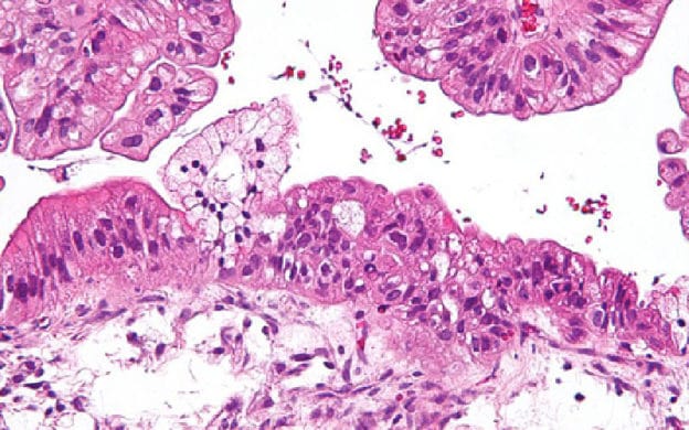 Du nouveau dans les projets de recherche sur le cancer de l’ovaire…